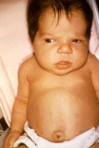 Jaundice in a newborn