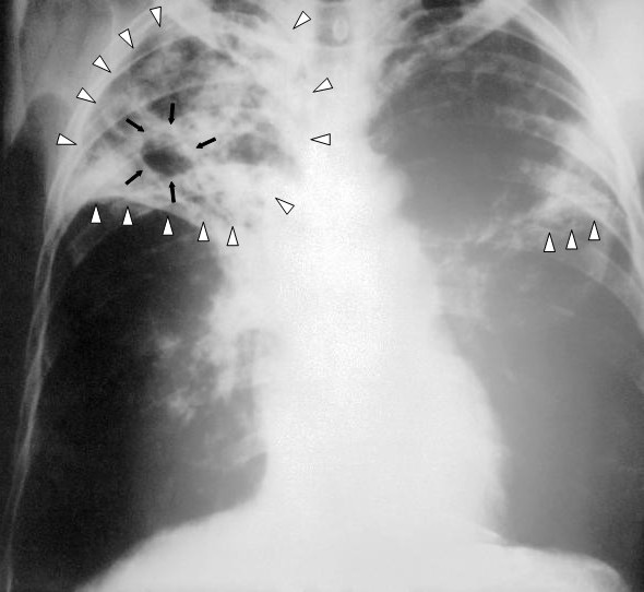 Read more about the article What you NEED to know about Tuberculosis (TB)