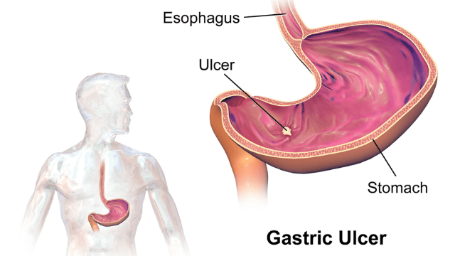 Read more about the article All you NEED to know about Peptic Ulcer Disease (PUD)