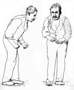 Parkinsonism